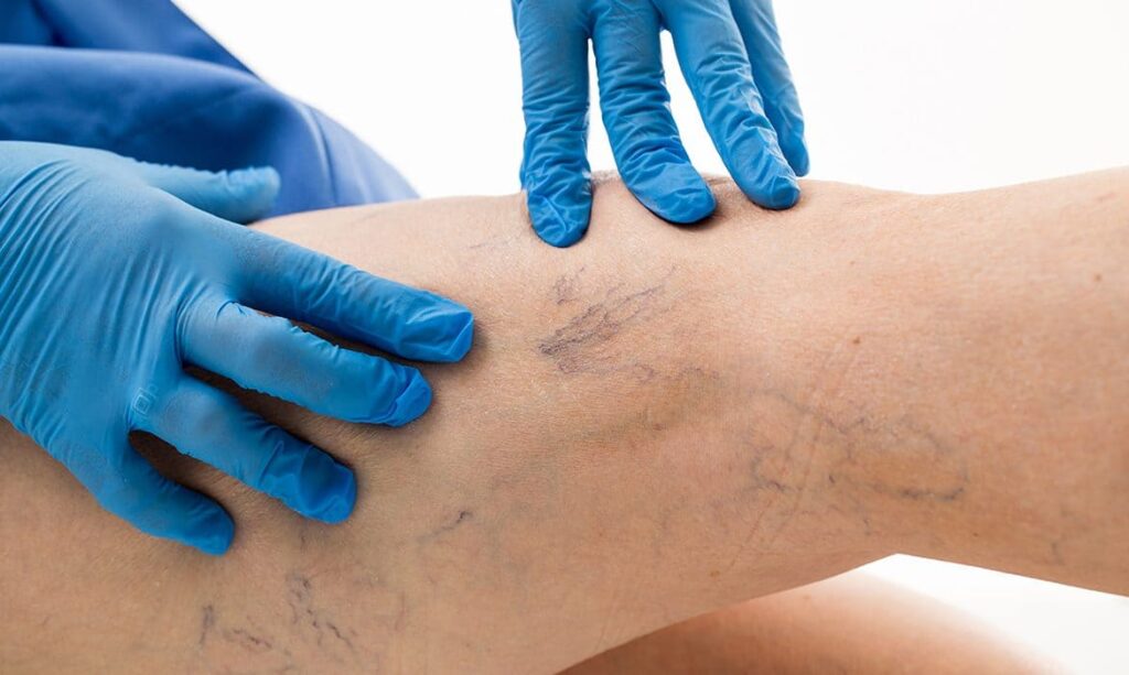 telenjektazi kılcal varis